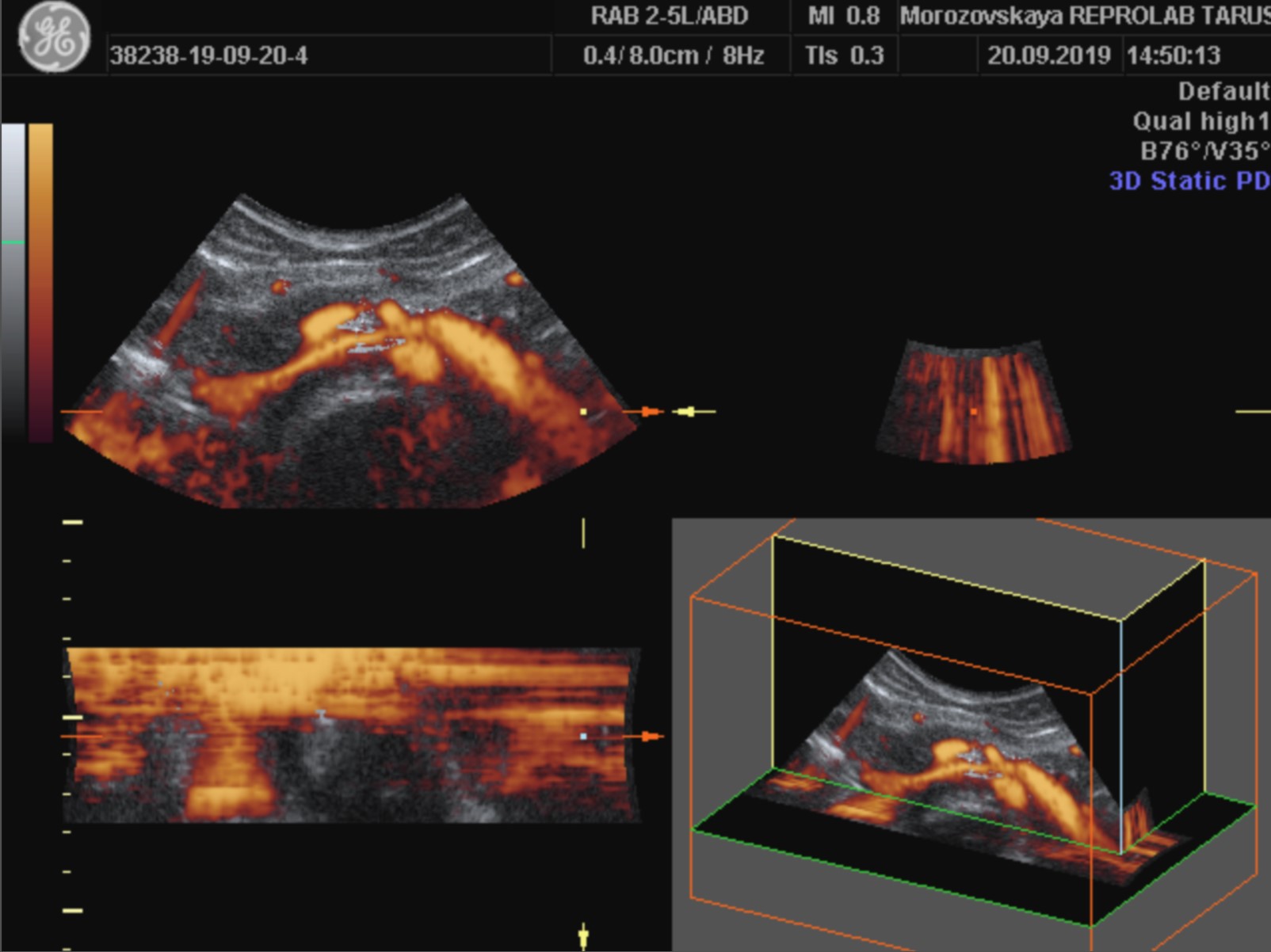 3D-реконструкция области аорто-мезентериального пинцета