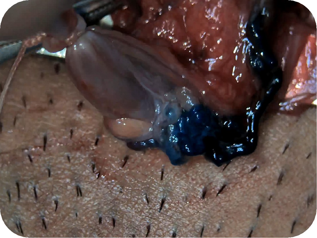 Больные вены перевязаны полностью, лимфатические сосуды сохранены абсолютно все