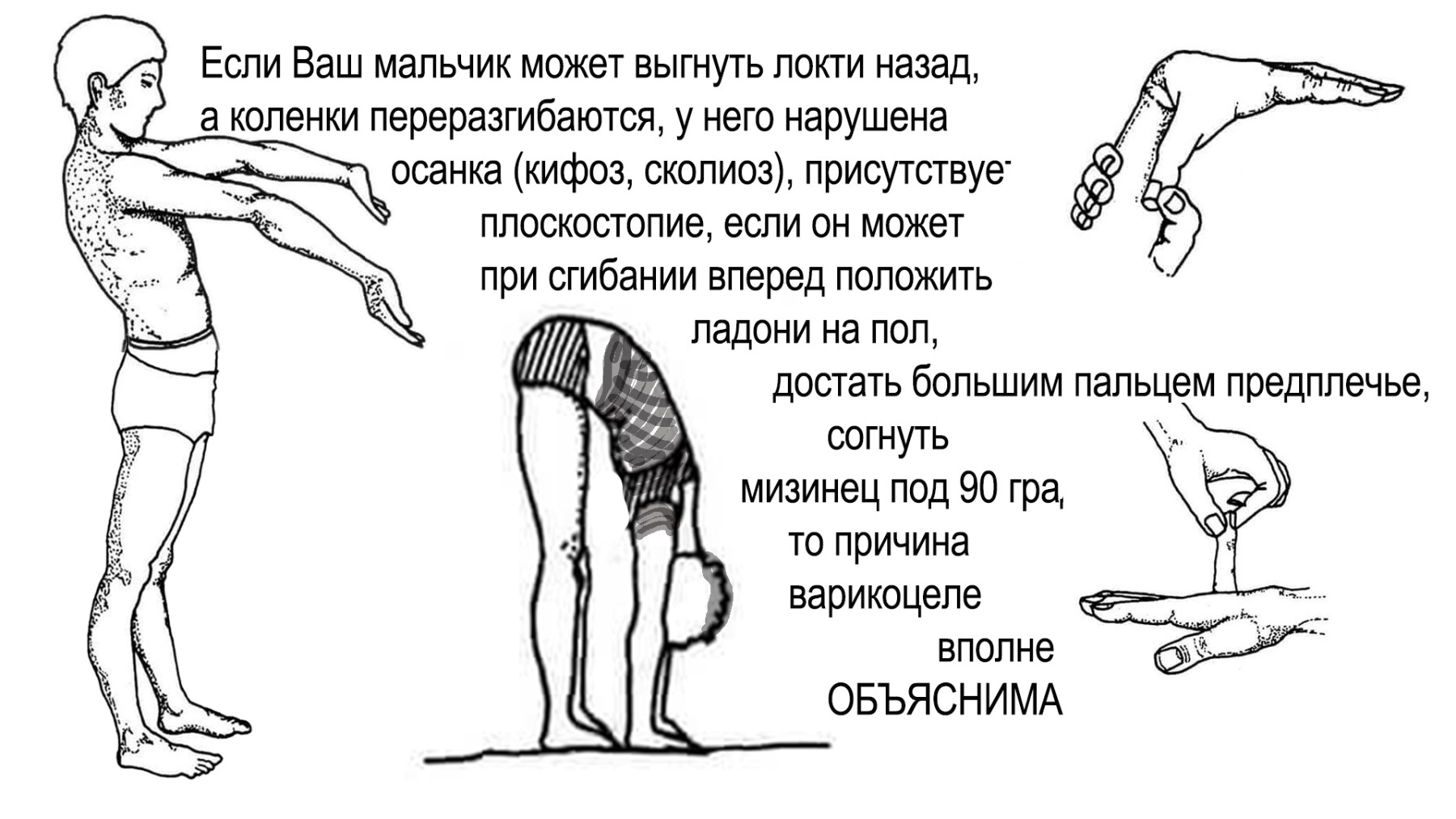 Признаки дисплазии соединительной ткани